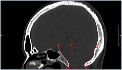 Correlation between bony structures of the posterior cranial fossa and the occurrence of hemifacial spasm